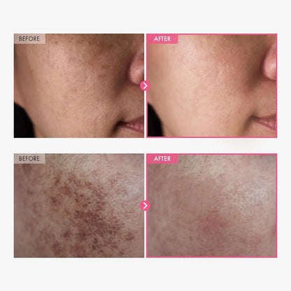 Arbutin 7% + Tranexamic Acid 4% Cream